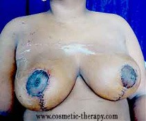 breast reduction surgery in kolkata