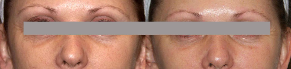 facelift surgery in kolkata