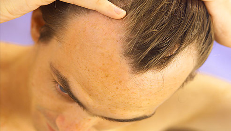 Hair Transplant in Kolkata by J. K. Saha