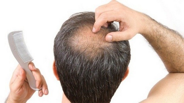 Best Treatment of Hair Loss Problem by Dr. J. K. Saha