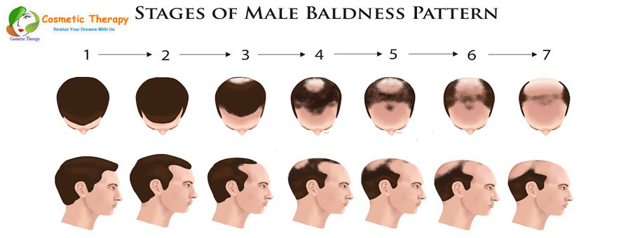 Rapid Hair Loss | Hair Fall problem | Kolkata | Hair Transplant Clinic