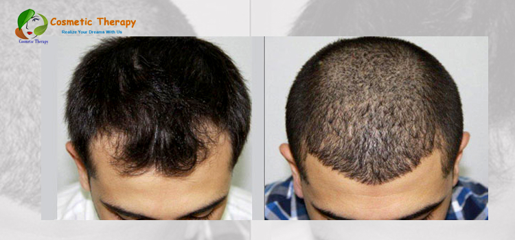 Different types of Hair transplantation methods – FUT & FUE