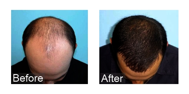 Hair Transplantation – 5 Things You Should Know