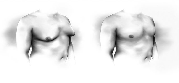 Gynecomastia: Could it cause breast cancer in men?